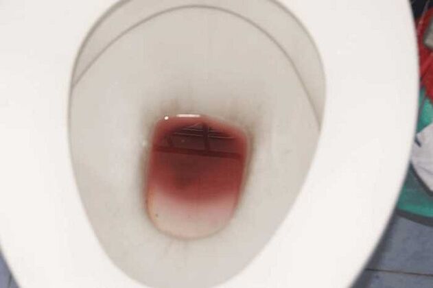 қозған кезде ерлерде дақтардың пайда болуы